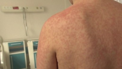 Odra na Pomorzu. Wszyscy chorzy to obywatele Ukrainy