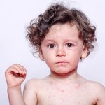 Odra: ryzyko choroby a ryzyko szczepienia