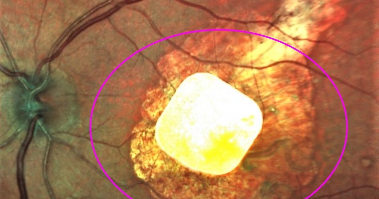 Oko pacjenta z wszczepionym implantem /123RF/PICSEL