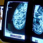 ​Onkolodzy: Przez koronawirusa musimy ograniczać liczbę wizyt chorych na nowotwory