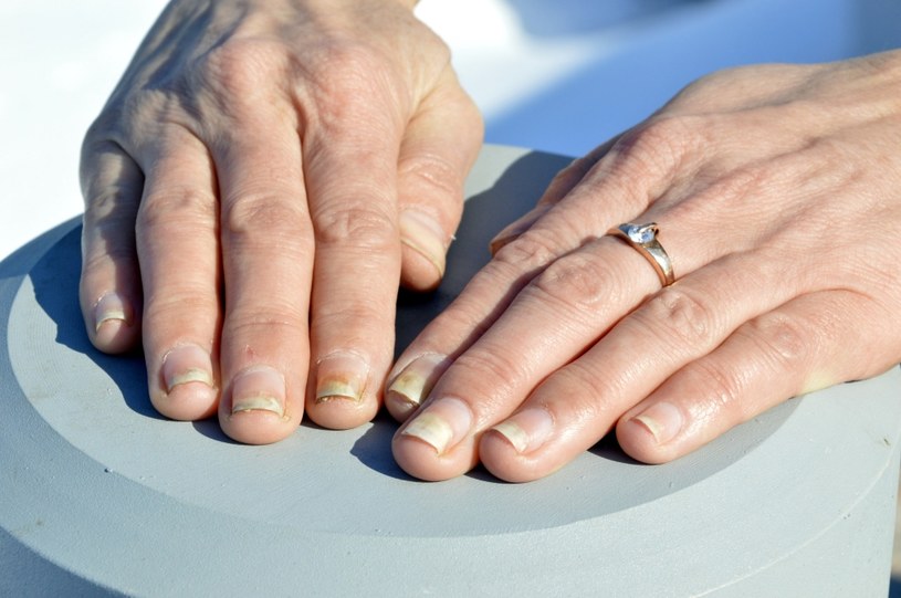 Onycholiza paznokci objawia się płytką odklejającą się od skóry, rosnącą jakby ku górze /123RF/PICSEL