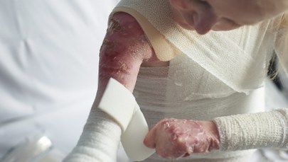 Opatrunki dla chorych na EB będą tańsze. Powstanie specjalna grupa refundacyjna