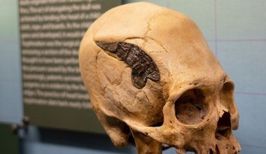 Operacja czaszki sprzed 2000 lat! Metalowy implant znalazł się w głowie