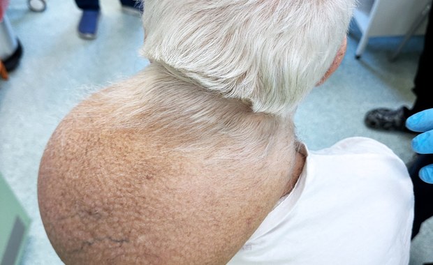 Operacja guza ważącego prawie 3 kg. Pacjent miał go na szyi