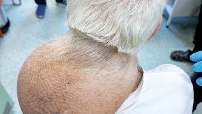 Operacja guza ważącego prawie 3 kg. Pacjent miał go na szyi