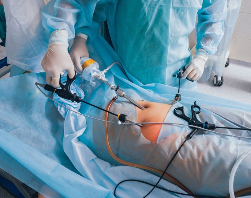 Operacja laparoskopowa przeprowadzana jest w częściowym znieczuleniu /123RF/PICSEL