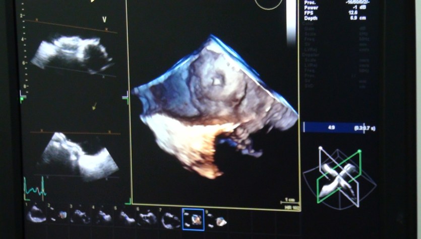 Operacja serca w technice 3D