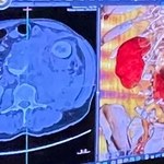 Operowali go w urodziny. "Dostał" drugie życie