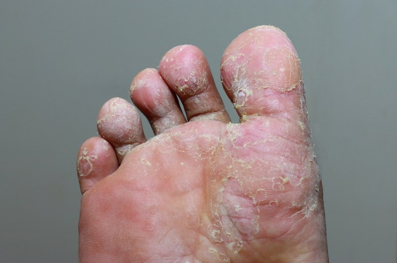 Retrasar el tratamiento de la infección por hongos puede provocar la propagación de las lesiones a todo el pie / 123RF / PICSEL