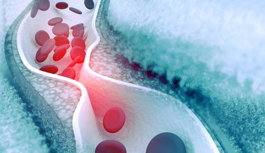 Opracowano nieinwazyjny sposób detekcji cholesterolu