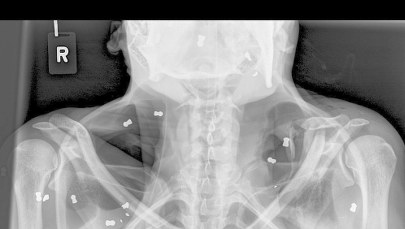 Orangutanica z 74 śrutami w ciele. Jej młode padło z głodu