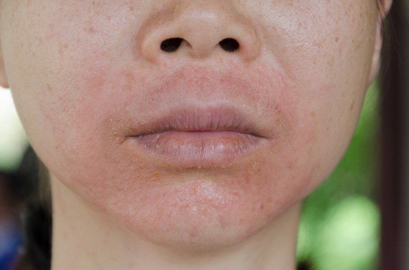 Osoby, które mają skłonność do alergii skóry powinny nosić maseczki z atestem lub zwracać szczególną uwagę na materiał, z którego maska została wykonana /123RF/PICSEL