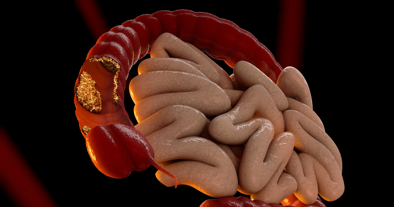 Osoby posiadające mutacje genów hMSH2 i hMLH1 mają 78-procentowe prawdopodobieństwo zachorowania na raka jelita grubego /123RF/PICSEL