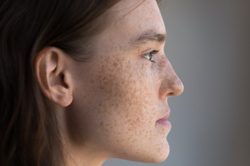 Osoby z pergaminową skórą są o wiele bardziej narażone na występowanie nowotworów skóry /123RF/PICSEL