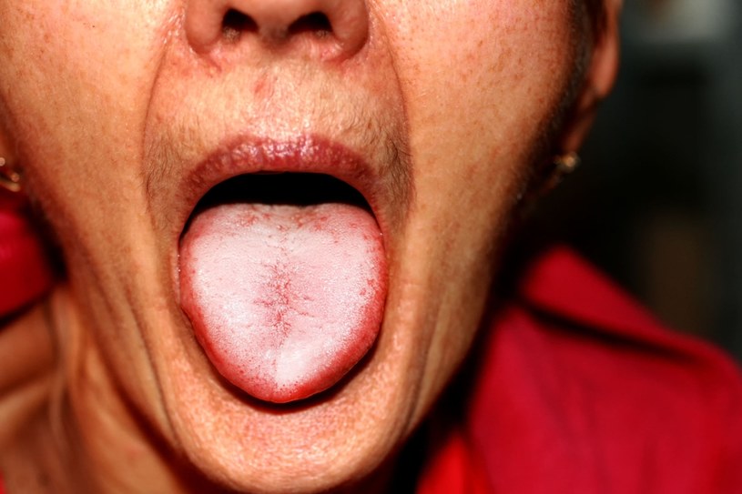 Ostry ból język to czasem objaw innej choroby. Najlepiej skonsultować się z lekarzem /123RF/PICSEL
