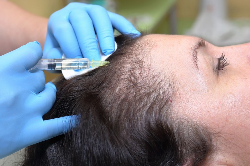 Ostrzykiwanie skóry głowy własnym osoczem ma pobudzić włosy do wzrostu /123RF/PICSEL