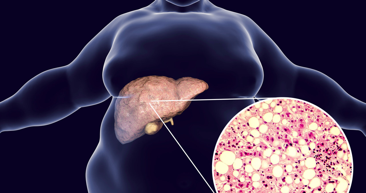 Otyłość brzuszna prowadzi do otłuszczenia wątroby, trzustki i serca, zwiększając ryzyko chorób tych narządów /123RF/PICSEL