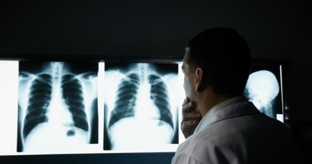 Pacjenci po przeszczepie płuc bez cukrzycy żyją dłużej /123RF/PICSEL