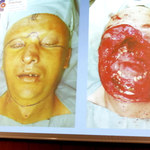 Pacjent po przeszczepie twarzy wychodzi ze szpitala