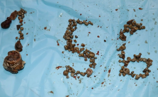 Pacjent z 156 kamieniami nerkowymi. Lekarze mówią o rekordzie 