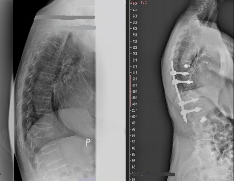 Pacjentka przed i po operacji /materiały prasowe
