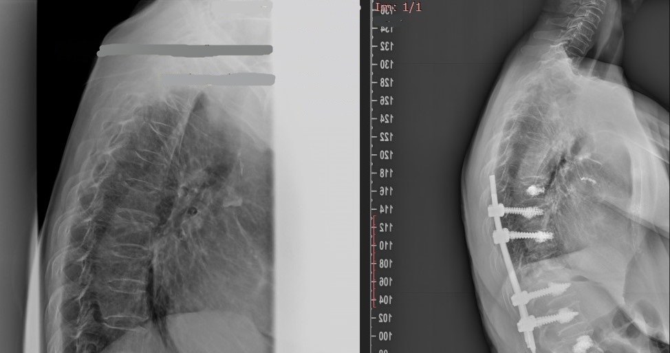 Pacjentka przed i po operacji /materiały prasowe