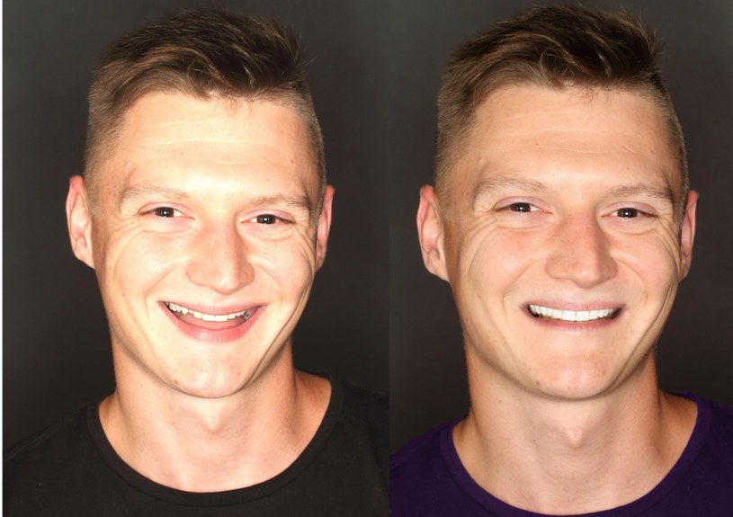 Pan Rafał po dwóch miesiącach leczenia zyskał piękne, proste zęby /Polsat Cafe