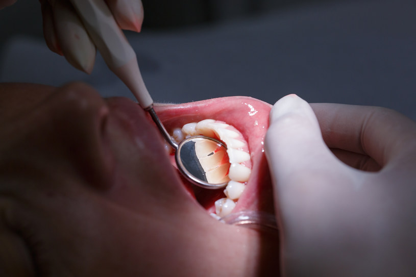 Paradontoza często atakuje zęby /123RF/PICSEL