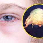 Pasożyt często zagnieżdża się w rzęsach. Przykre objawy nasilają się w nocy