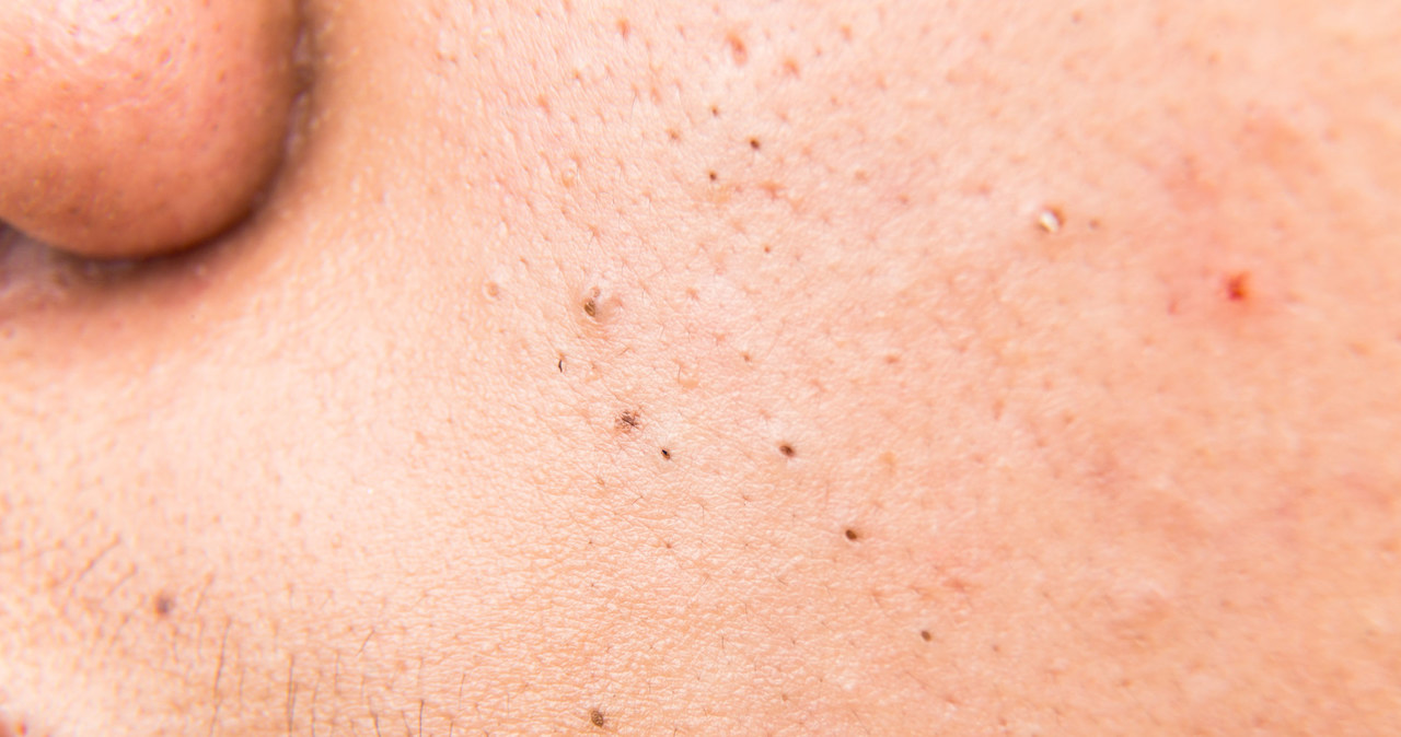 Pasożyty skórne często mylone są z innymi chorobami dermatologicznymi /123RF/PICSEL