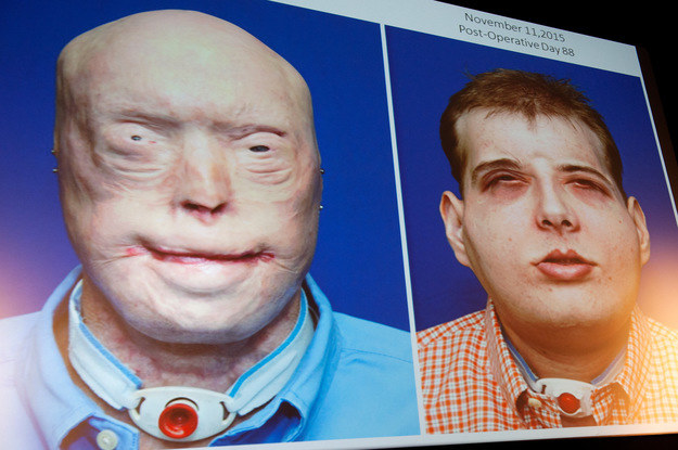 Patrick przed i po operacji przeszczepienia twarzy /AFP