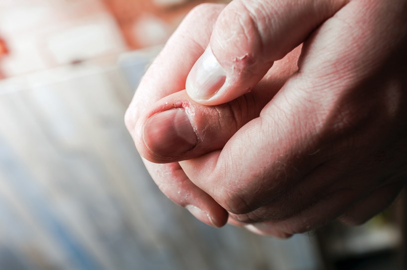 Paznokcie obgryzają nie tylko dzieci, ale też dorośli. Przyczyną mogą być poważne problemy natury psychicznej i emocjonalnej /123RF/PICSEL