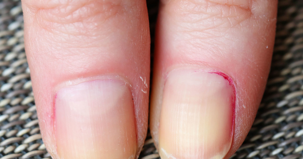 Pękające paznokcie mogą świadczyć o dużych niedoborach witamin /123RF/PICSEL