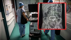Pięciolatek połknął 52 magnetyczne kulki. Matka ostrzega rodziców
