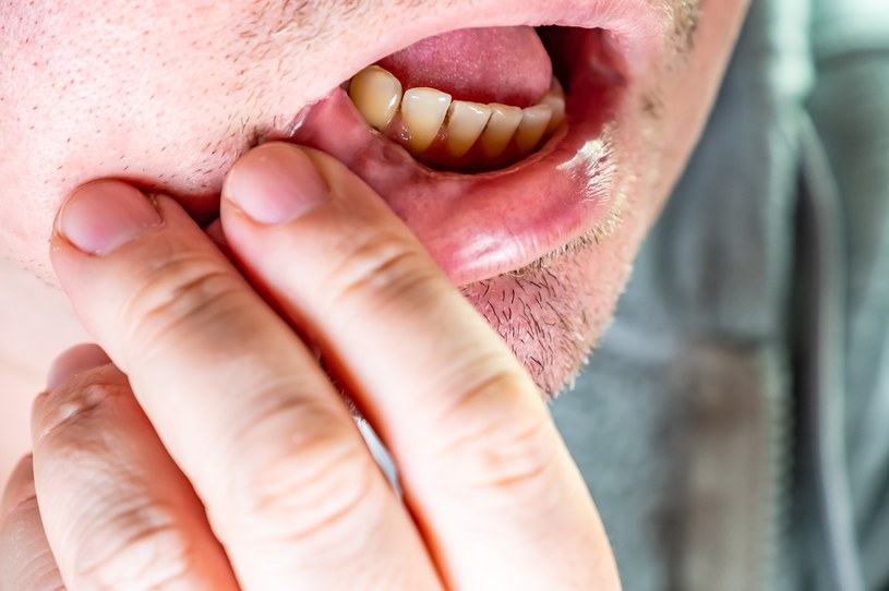 Pieczenie w jamie ustnej może utrzymywać się miesiącami. Co może być przyczyną? /123RF/PICSEL