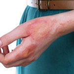 ​Pierwsza pomoc w oparzeniach. ​Tego absolutnie nie rób!