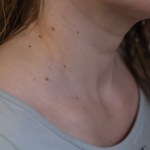 Pierwsze objawy raka tarczycy. Trzy z nich zauważysz w obrębie szyi