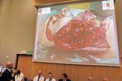 Pierwszy przeszczep twarzy w Polsce. Uwaga! Drastyczne zdjęcia