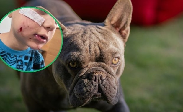 ​Pies pogryzł twarz 4-letniego Frania. Rodzice szukają właściciela czworonoga
