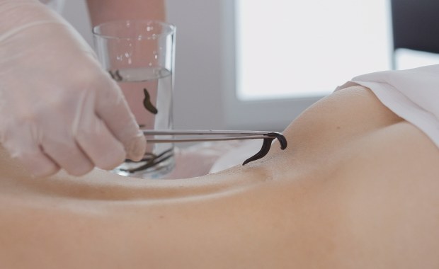 Pijawki medyczne. Na co pomagają?