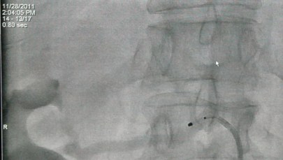 Pionierska operacja w Krakowie