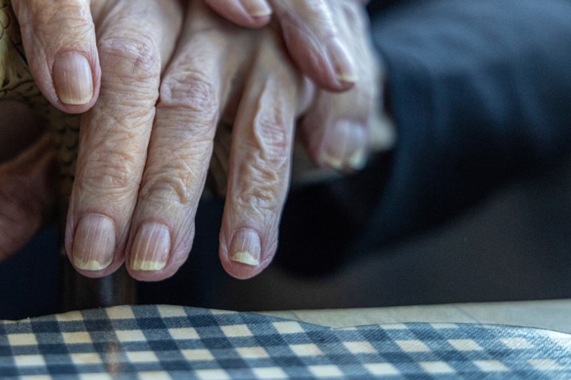Pionowe bruzdy na paznokciach często występują u osób starszych, ale warto wiedzieć, że mogą świadczyć o chorobach /123RF/PICSEL