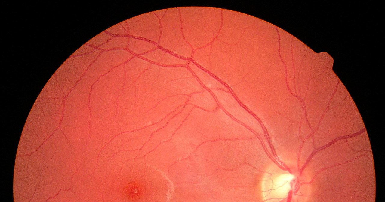 Plamka żółta to niewielki fragment siatkówki, zabarwiony na żółto /123RF/PICSEL