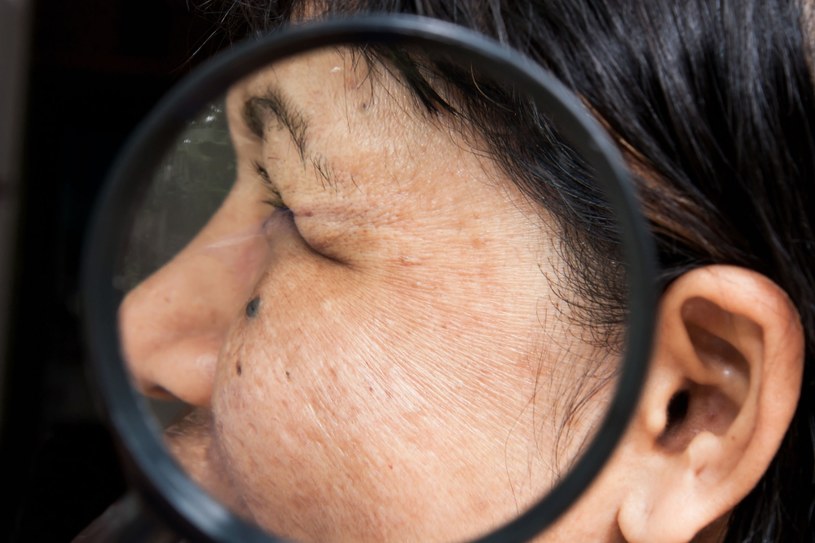 Plamki na twarzy mogą świadczyć o chorobie, dlatego warto im się przyglądać i skonsultować się z lekarzem /123RF/PICSEL