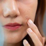 Plasterki na wypryski - hit czy kit? Co wybrać, co w składzie, czy kształt ma znaczenie? 