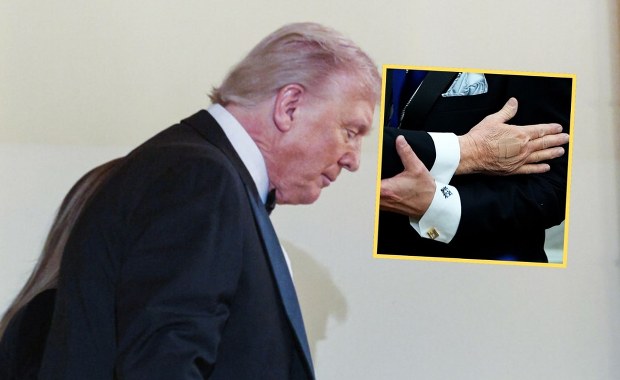 Plastry na dłoni Donalda Trumpa. Rzeczniczka mówi o powodach