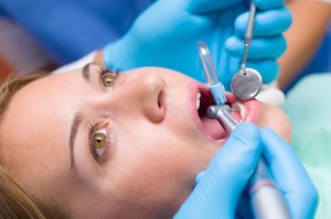 Plomby z tlenkiem grafenu to przyszłość stomatologii?