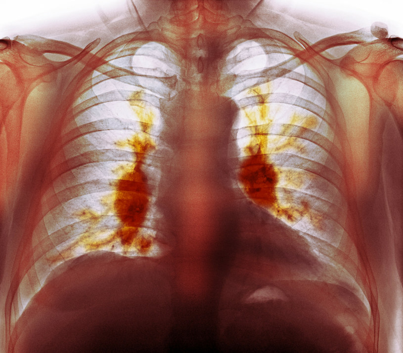 Płuca osoby chorej na sarkoidozę /DR P. MARAZZI/Science Photo Library/East News /East News