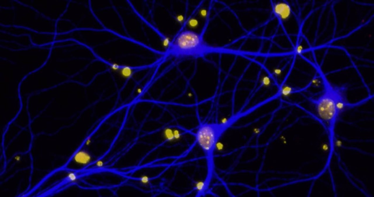 Płytki amyloidowe w mózgu redukują poziom BRCA1 (czerwone) w neuronach (niebieskie) /materiały prasowe