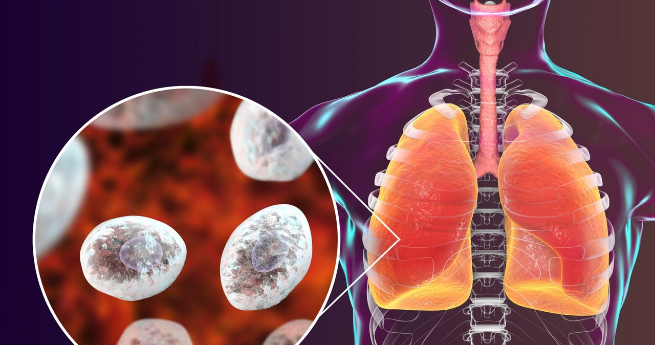 Pneumocystoza rozwija się niemal wyłącznie u osób z osłabionym układem odpornościowym. Najliczniejszą grupą pacjentów są chorzy z zakażeniem HIV /123RF/PICSEL